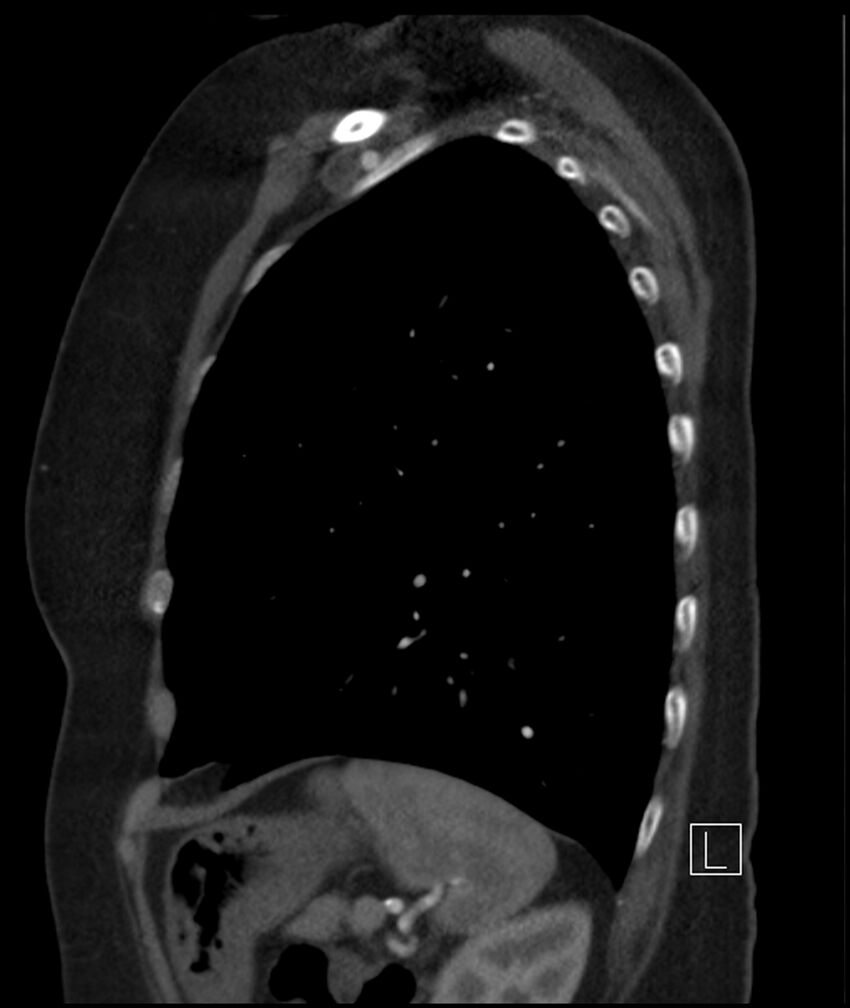 Adenocarcinoma of the lung (Radiopaedia 44205-47803 Sagittal C+ portal venous phase 14).jpg