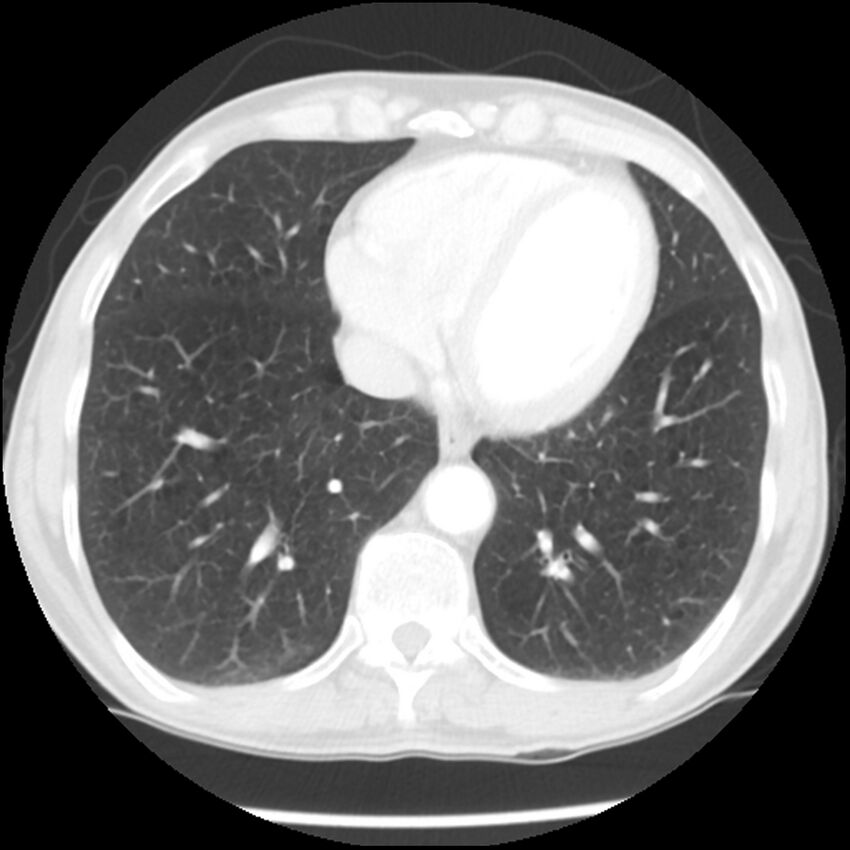 Adenocarcinoma of the lung - micropapillary predominant (Radiopaedia 42446-45563 Axial lung window 54).jpg