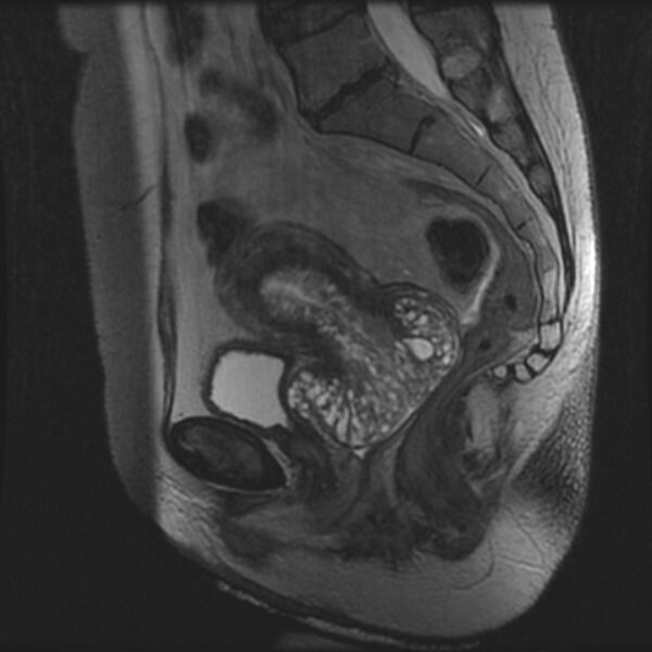 File:Adenoma malignum of the cervix (Radiopaedia 24460-24765 T2 56).jpg