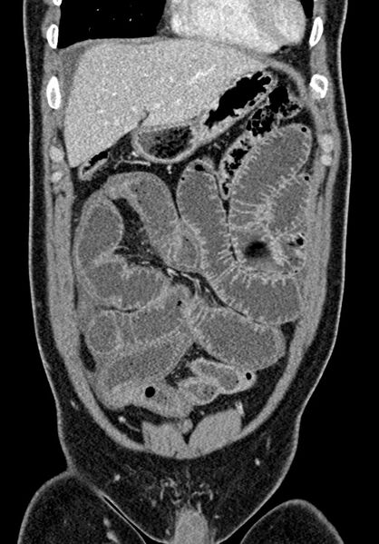 File:Adhesional small bowel obstruction (Radiopaedia 58900-66131 Coronal C+ portal venous phase 90).jpg