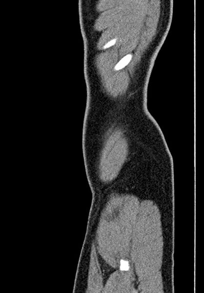 File:Adhesional small bowel obstruction (Radiopaedia 58900-66131 Sagittal C+ portal venous phase 10).jpg