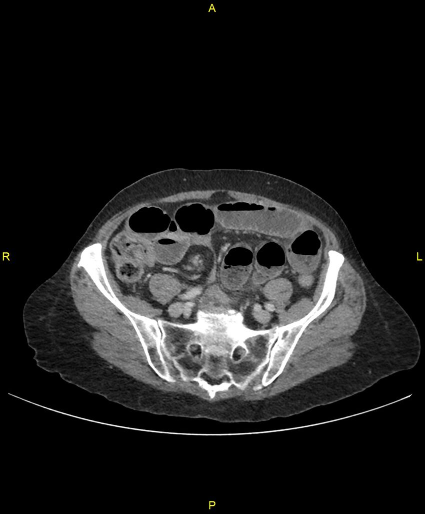 Adhesional small bowel obstruction (Radiopaedia 85402-101024 Axial C+ portal venous phase 207).jpg