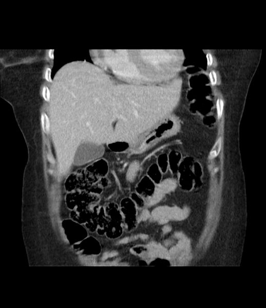 File:Adrenal cortical carcinoma with IVC invasion and thrombosis (Radiopaedia 34307-35597 Coronal C+ portal venous phase 17).jpg