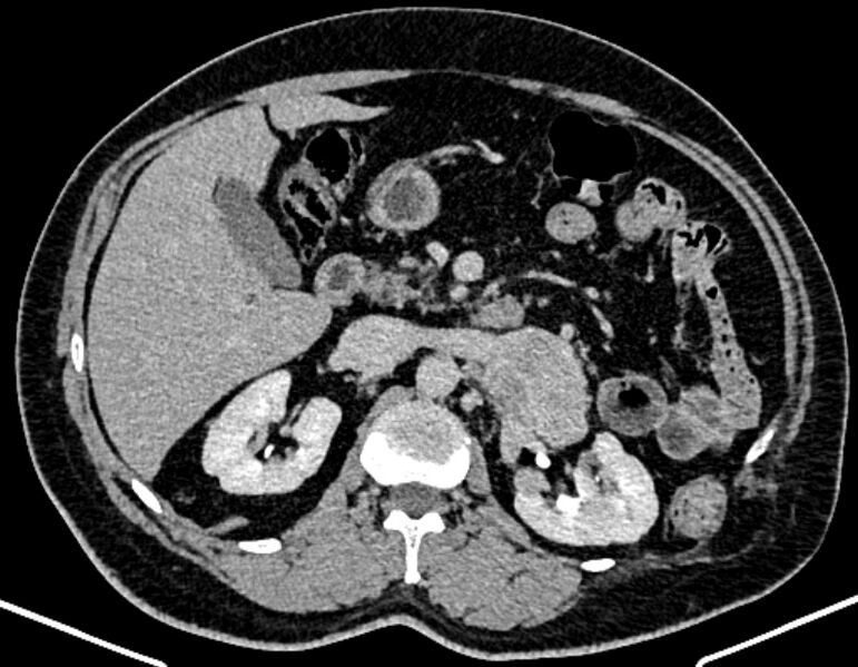File:Adrenal metastases (Radiopaedia 73082-83791 Axial C+ delayed 125).jpg