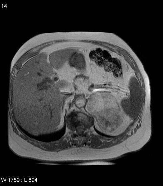 File:Adrenal myelolipoma (Radiopaedia 6765-7961 Axial T1 in-phase 14).jpg