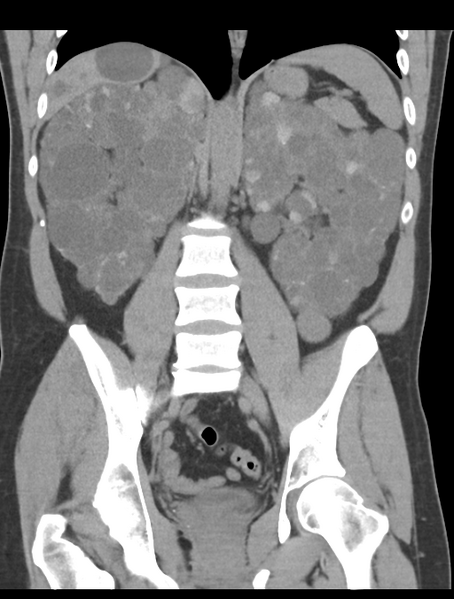 File:Adult polycystic kidney disease (Radiopaedia 47866-52626 Coronal non-contrast 30).png