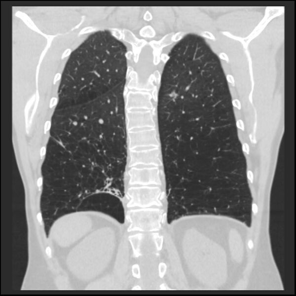 File:Alpha-1-antitrypsin deficiency (Radiopaedia 40993-43722 Coronal lung window 81).jpg