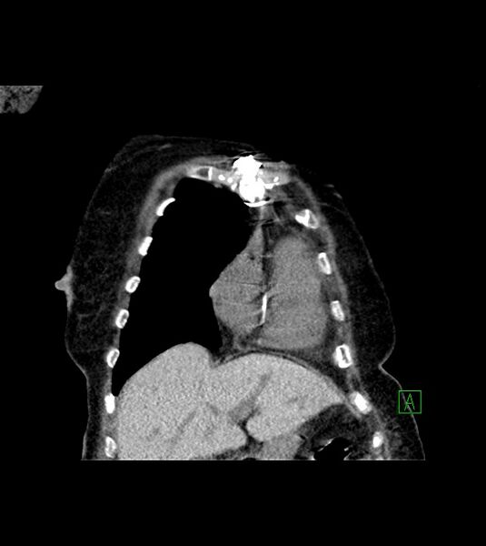 File:Amiodarone deposition in the liver (Radiopaedia 77587-89780 Coronal non-contrast 20).jpg
