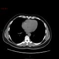 Ampullary carcinoma (Radiopaedia 56396-63056 Axial non-contrast 2).jpg