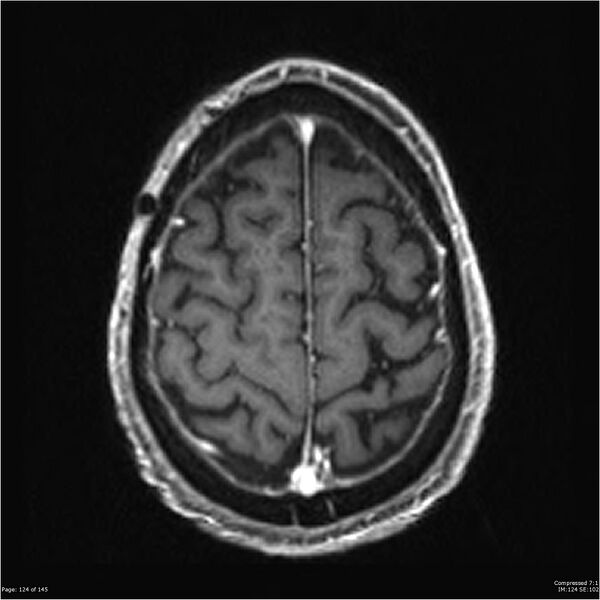File:Anaplastic meningioma with recurrence (Radiopaedia 34452-35788 Axial T1 C+ 124).jpg