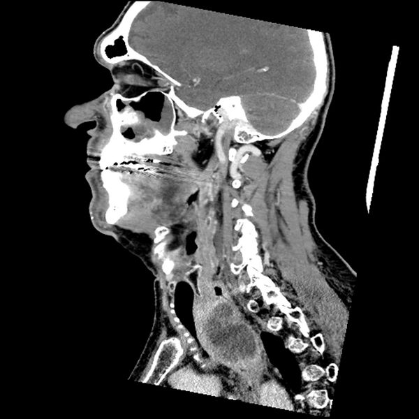 File:Anaplastic thyroid carcinoma (Radiopaedia 79087-92034 C 59).jpg