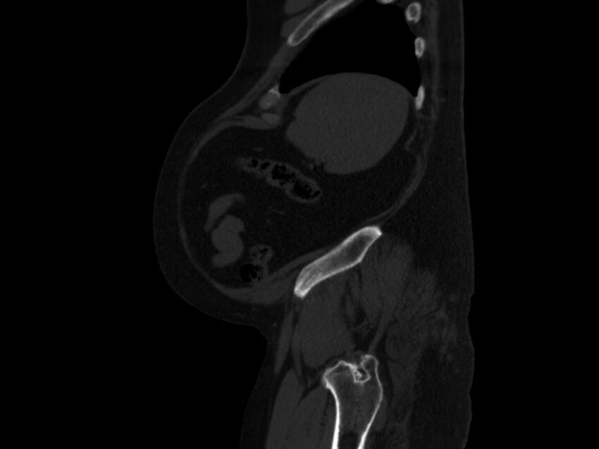 Ankylosing spondylitis (Radiopaedia 44609-48357 Sagittal bone window 100).jpg