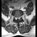 Ankylosing spondylitis with zygapophyseal arthritis (Radiopaedia 38433-40516 Axial T1 4).jpg