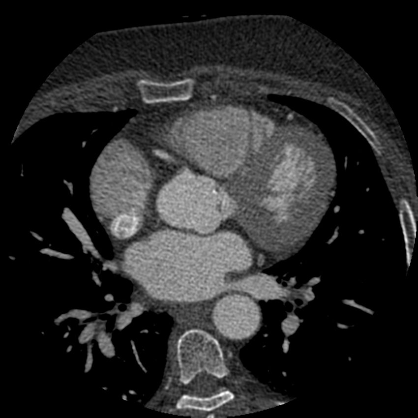 Anomalous origin of left circumflex artery from right coronary sinus (Radiopaedia 72563-83117 B 60).jpg