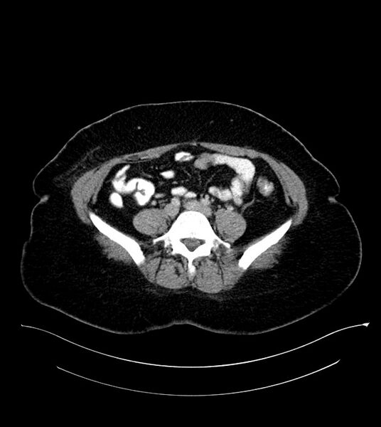 File:Anterior abdominal wall CSF pseudocyst (CSFoma) (Radiopaedia 79453-92571 A 62).jpg