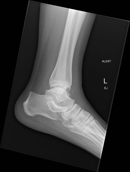 File:Anterior calcaneal process fracture (Radiopaedia 50110-55421 Lateral 1).jpg