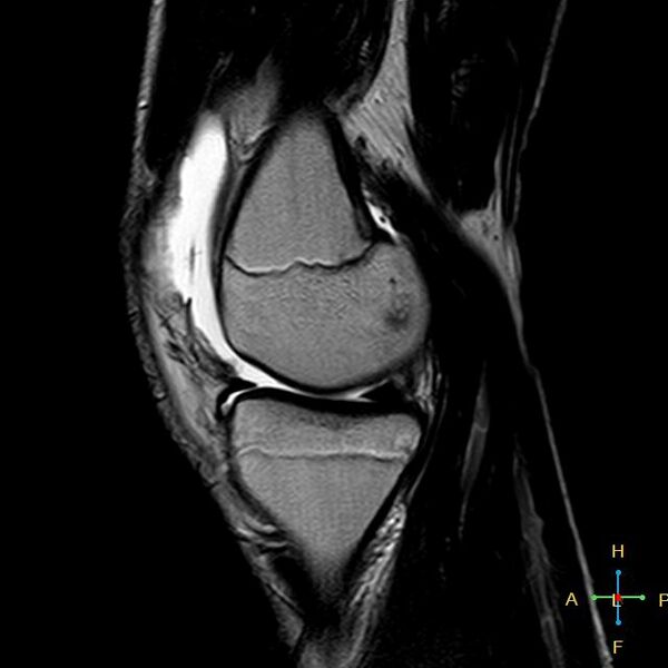 File:Anterior cruciate ligament tear - complete (Radiopaedia 24907-25170 Sagittal T2 13).jpg
