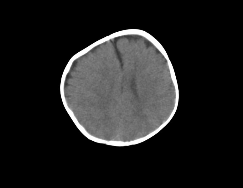 File:Anterior plagiocephaly (Radiopaedia 71836-82273 Axial non-contrast 14).jpg