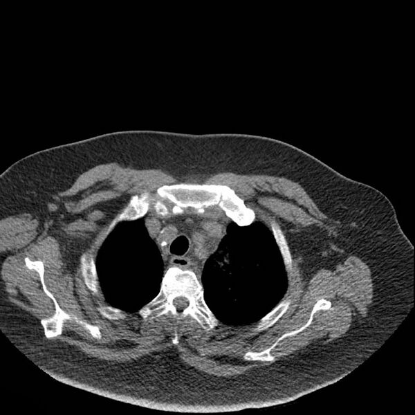 File:Aortic arch false aneurysm (Radiopaedia 14667-14587 Axial non-contrast 1).jpg