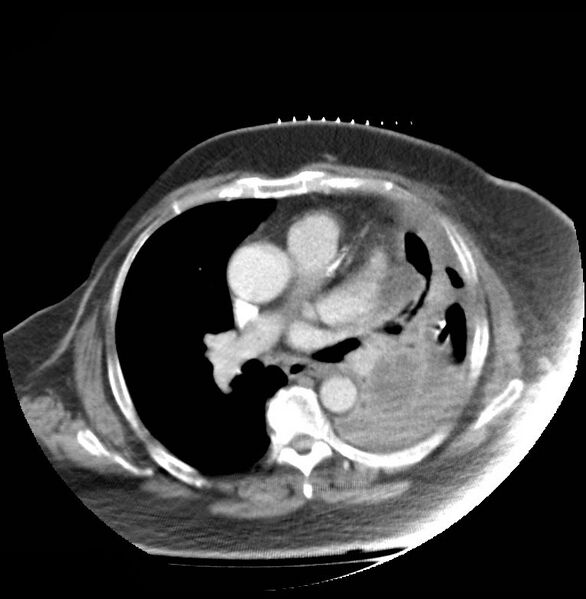 File:Aortic arch false aneurysm (Radiopaedia 14667-14588 A 13).jpg