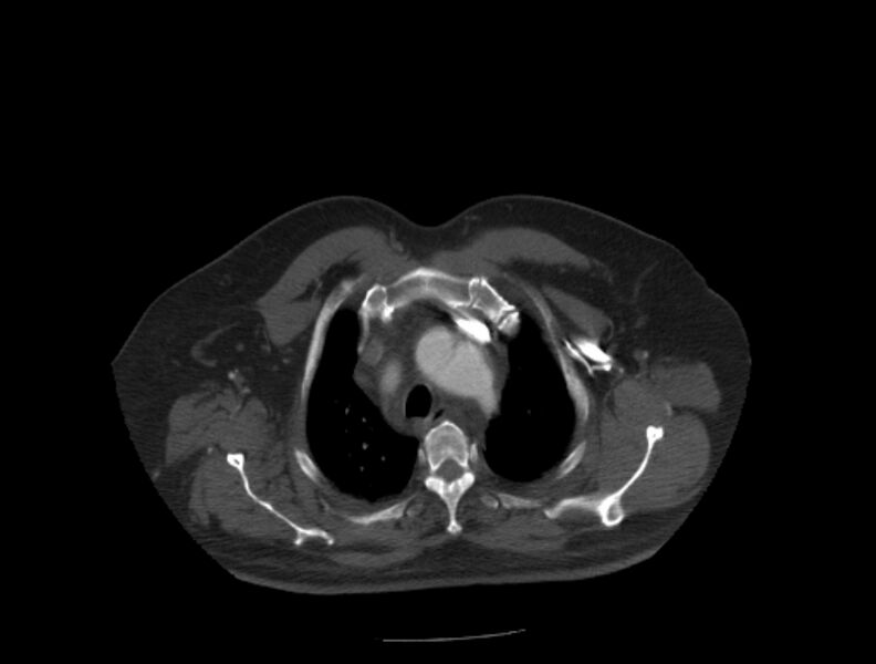 File:Aortic dissection (Radiopaedia 28802-29105 A 2).jpg