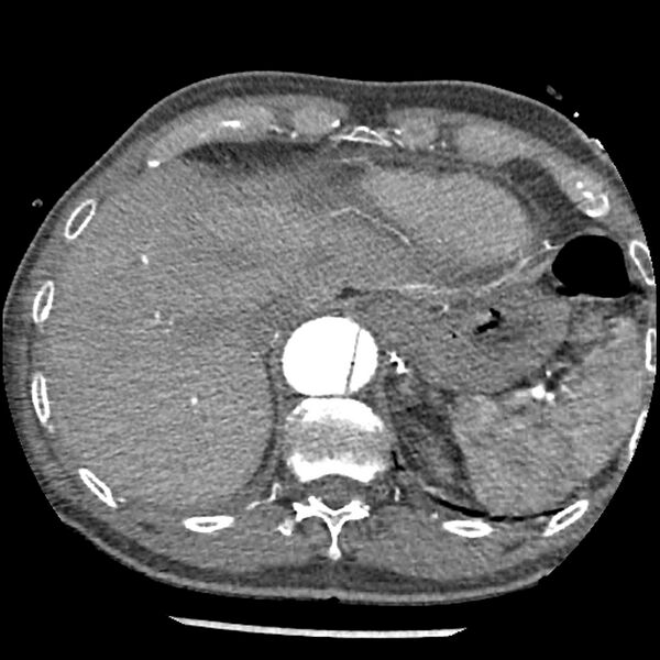 File:Aortic dissection - DeBakey Type I-Stanford A (Radiopaedia 79863-93115 A 35).jpg