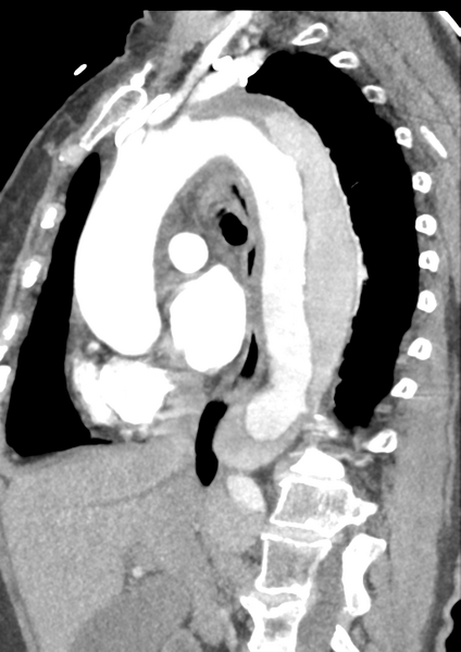 File:Aortic dissection - Stanford type B (Radiopaedia 50171-55512 C 30).png