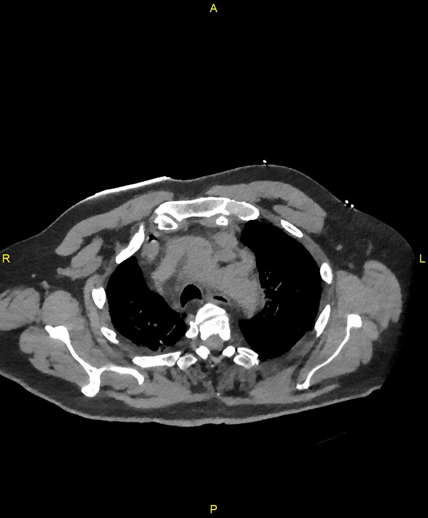 Aortic rupture (Radiopaedia 88822-105594 Axial non-contrast 38).jpg