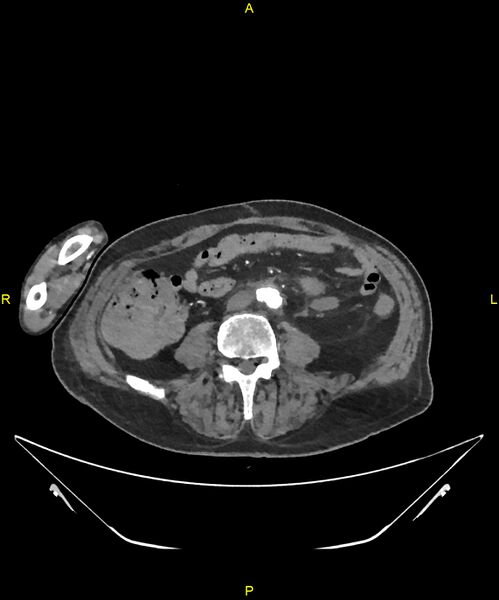 File:Aortoenteric fistula (Radiopaedia 84308-99603 B 224).jpg