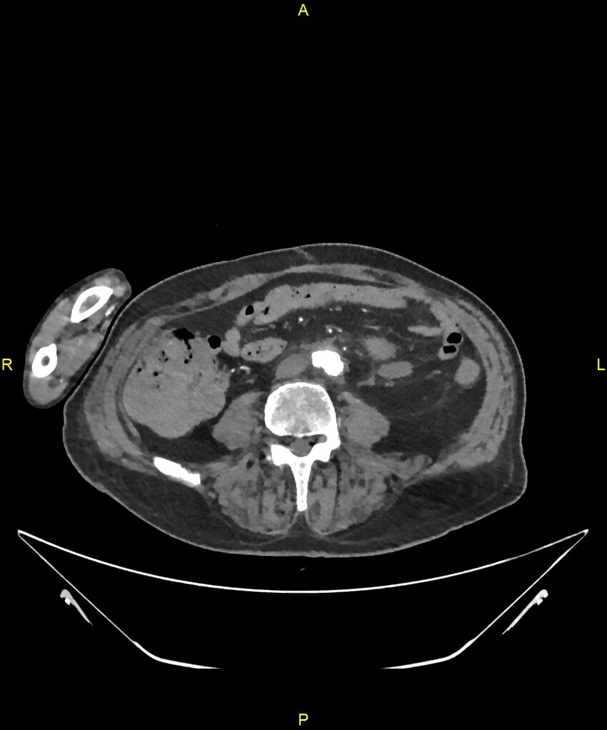 Aortoenteric fistula (Radiopaedia 84308-99603 B 224).jpg
