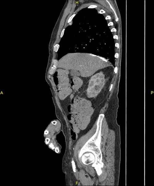 File:Aortoenteric fistula (Radiopaedia 84308-99603 C 88).jpg