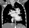 Aortopulmonary window, interrupted aortic arch and large PDA giving the descending aorta (Radiopaedia 35573-37074 D 38).jpg