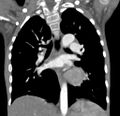 Aortopulmonary window, interrupted aortic arch and large PDA giving the descending aorta (Radiopaedia 35573-37074 D 42).jpg