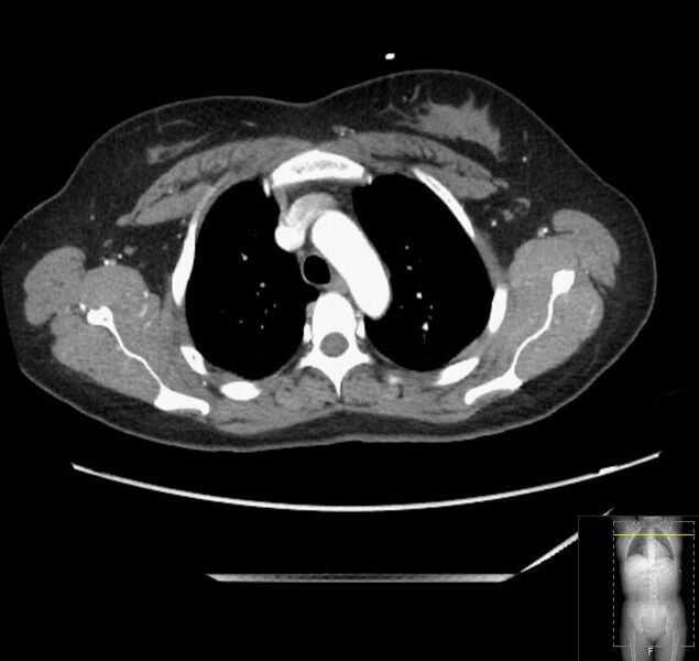 File:Appendicitis (CT angiogram) (Radiopaedia 154713-127660 Axial 221).jpg