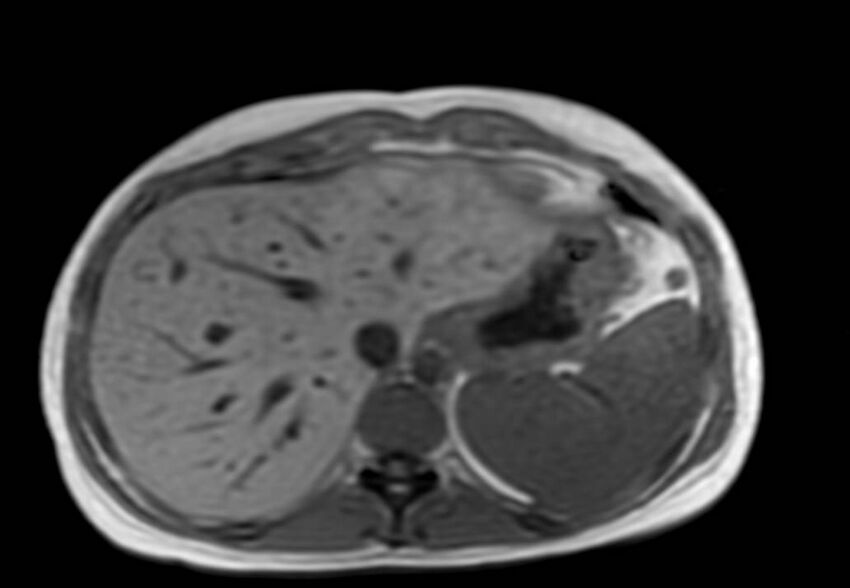 Appendicitis in gravida (MRI) (Radiopaedia 89433-106395 Axial T1 in-phase 7).jpg