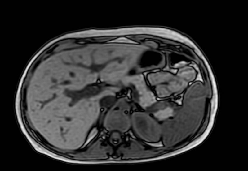 File:Appendicitis in gravida (MRI) (Radiopaedia 89433-106395 D 13).jpg
