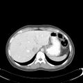 Appendicitis with minimal stranding but appendicolith (Radiopaedia 29035-29397 A 15).jpg