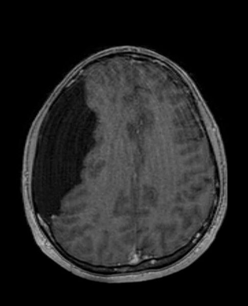 File:Arachnoid cyst- extremely large (Radiopaedia 68741-78451 Axial T1 C+ 55).jpg