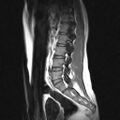 Arachnoid cyst - spinal (Radiopaedia 66835-76157 Sagittal T1 8).jpg