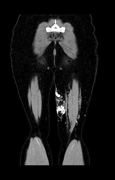File:Arteriovenous malformation - thigh (Radiopaedia 14948-14883 None 16).jpg