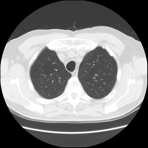 File:Asbestos-related pleural plaques (Radiopaedia 39069-41255 Axial lung window 14).jpg