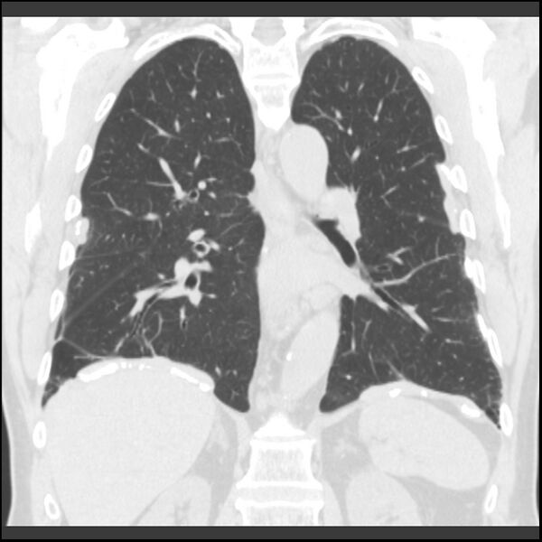 File:Asbestos-related pleural plaques (Radiopaedia 39069-41255 Coronal lung window 34).jpg