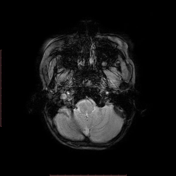 File:Astroblastoma (Radiopaedia 74287-85162 Axial SWI 2).jpg