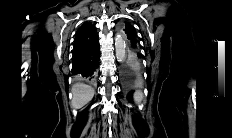 File:Atypical dissection of the thoracic aorta (Radiopaedia 10975-78320 B 40).jpg