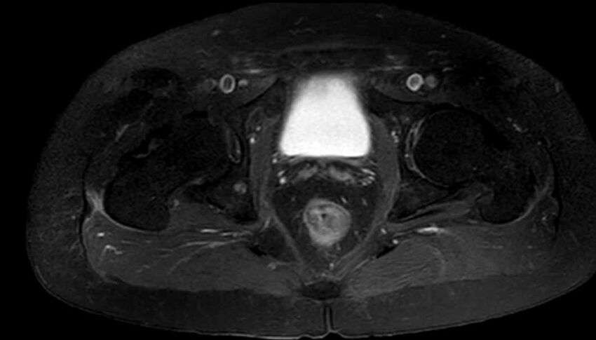 Atypical lipomatous tumor - thigh (Radiopaedia 68975-78734 Axial T1 C+ fat sat 91).jpg