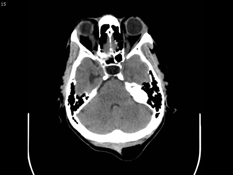 File:Atypical meningioma - intraosseous (Radiopaedia 64915-73867 A 15).jpg