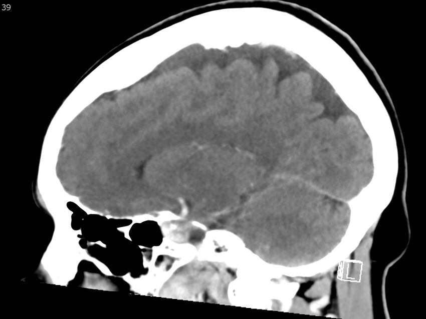 Atypical meningioma - intraosseous (Radiopaedia 64915-73867 F 38).jpg