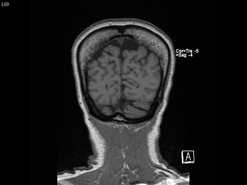 File:Atypical meningioma - intraosseous (Radiopaedia 64915-74572 Coronal T1 169).jpg