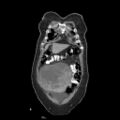 Atypical retroperitoneal lymphocoeles with large leiomyoma of uterus (Radiopaedia 32084-33024 B 2).jpg