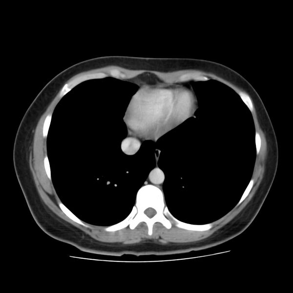 File:Autosomal dominant polycystic kidney disease (Radiopaedia 23061-23093 C 3).jpg